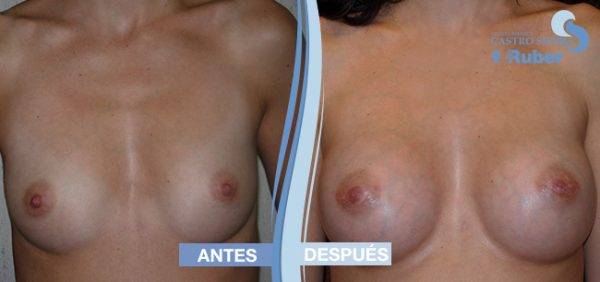 Tetas aumento antes y después. Clínica Ruber Madrid