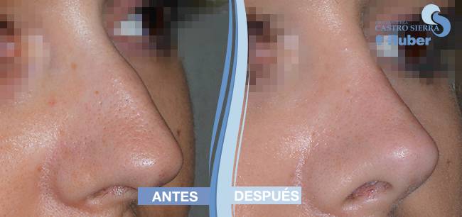 operación de rinoplastia en Madrid