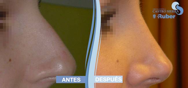 Rinoplastia Madrid