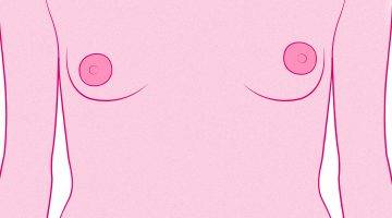asimetria pecho aumento mamas