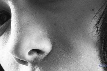 rinoplastia tipos nariz