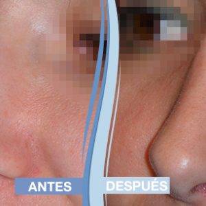 comparar resultados rinoplastia