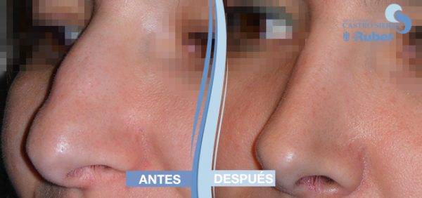 comparar resultados rinoplastia