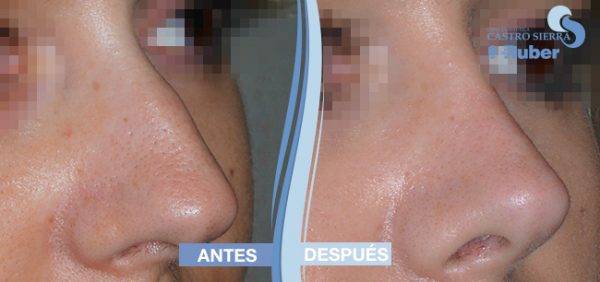 comparar resultados rinoplastia