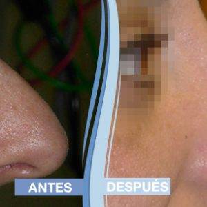 comparar resultados rinoplastia