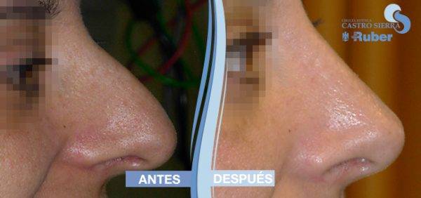 comparar resultados rinoplastia