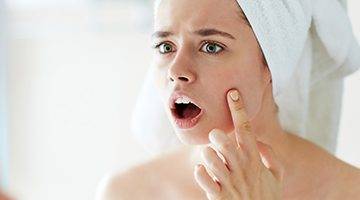 acné y sus causas