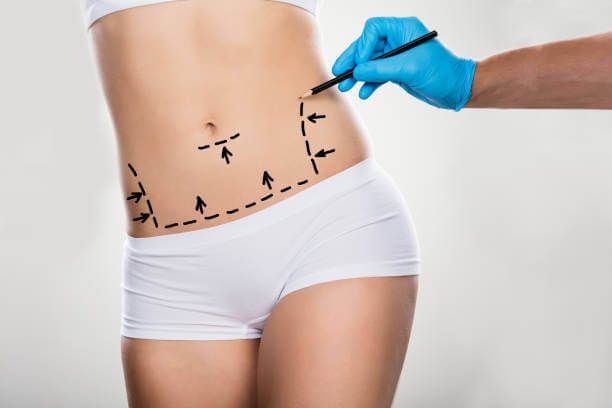 operacion de abdominoplastia