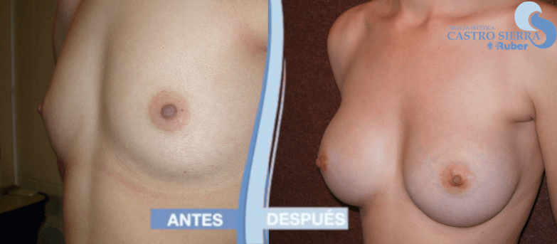 Antes y después de aumento de pecho