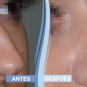 Operación de rinoplastia