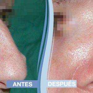 Operación de rinoplastia