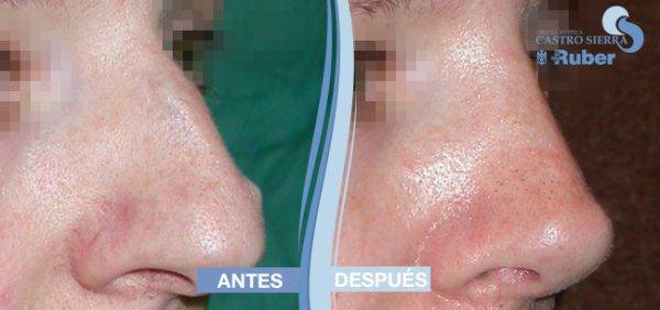 Operación de rinoplastia