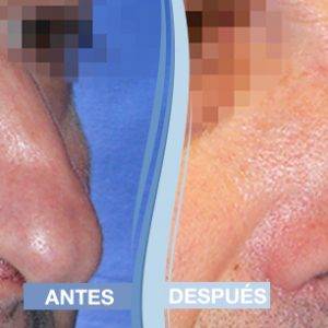 Operación de rinoplastia