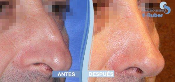 Operación de rinoplastia