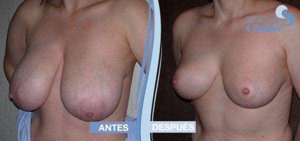 Operación de reducción de mamas