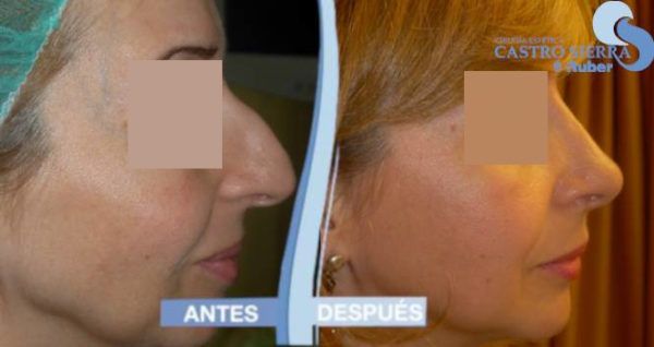 rinoplastia-madrid-2-nuevo