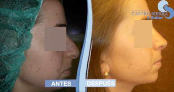 rinoplastia-madrid-1-nuevo